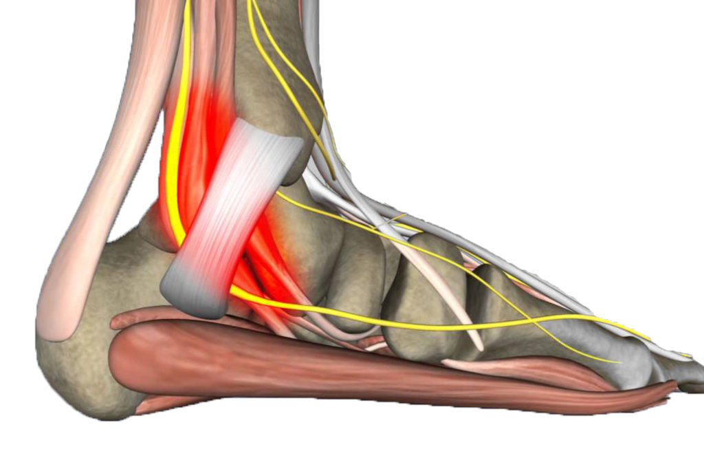 Etf Clinical Case Tarsal Tunnel Syndrome Obrien Medical
